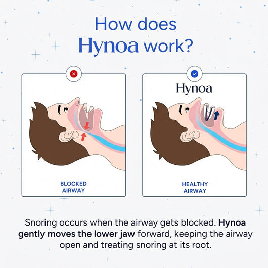 Hynoa | Anti-Snoring Mouthpiece